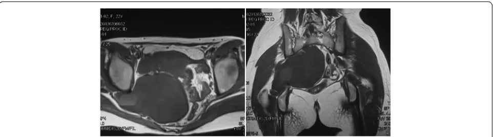 Fig. 3 Patient with large presarcral tumor underwent excision of the presacral tumor by the da Vinci robotic surgical system, followed by aposterior approach