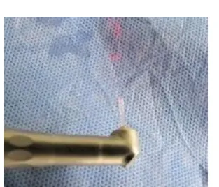 Fig. 1. Laser handpiece (R14) with chisel tip 
