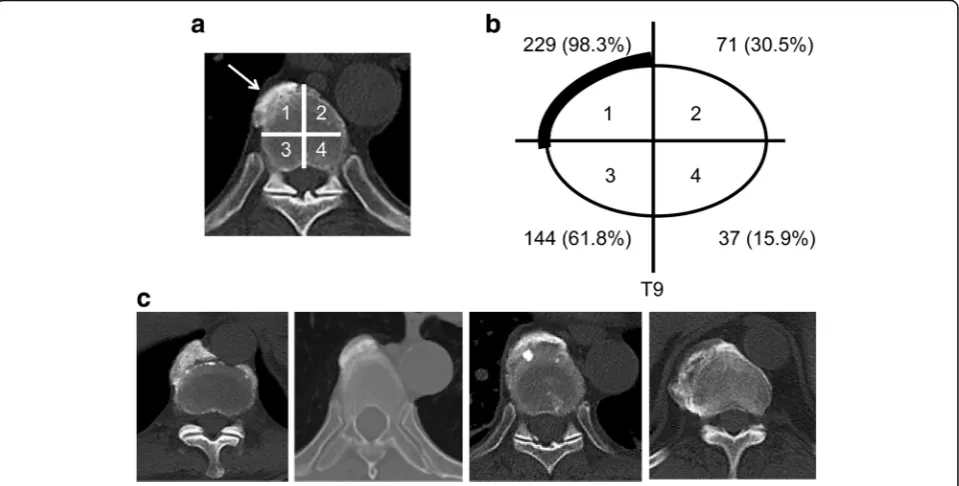 Table 3 Among 233 subjects who had consecutive ossificationin T8 - T10, 142 subjects were found at the apex of the thoracickyphosis at T8 - T10