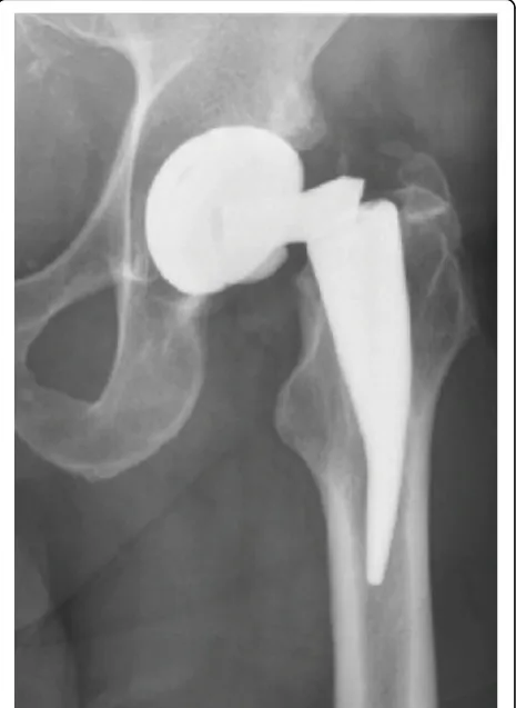 Figure 1 X-ray of a hip with a failed neck.