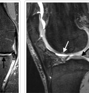 Figure 1 Coronal PD-weighted TSE MRI of a 68-year-old woman. Tibial medial MRI shows a full-thickness defect of the cartilage with de-nudation of the bone (black arrow)