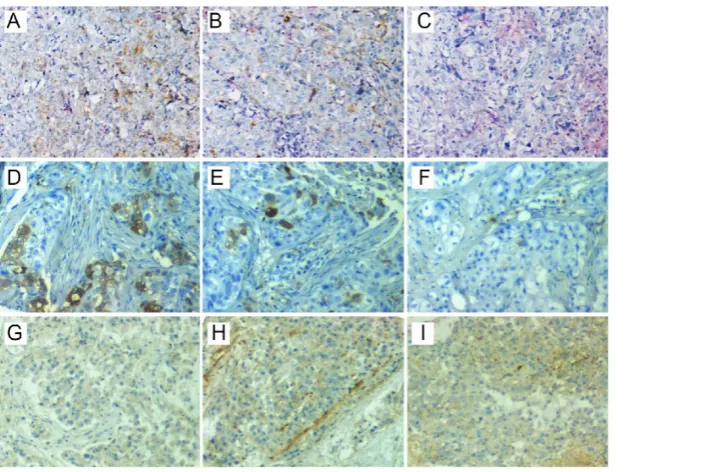 Figure 2. Representative staining of ITSH in three patients. CD44patient (+/CD24- was positive in one region (C), but positive in the other two regions (A and B) of the first A-C)