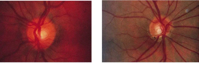 Figure 3.1 Example of optic disc photography a) normal disc b) notching in optic disc (Courtesy: Handbook of Glaucoma (Azuara-Blanco Augusto) 