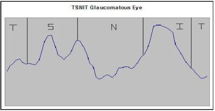 Figure 3.7a Nerve fiber layer thickness double-hump patter for non-glaucomatous eye 