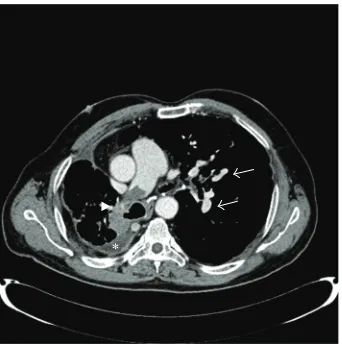 Figure 1: Computed tomography scan of the chest with contrastshowing a pulmonary embolus in the right main pulmonary artery(arrow head), with calcified lymph nodes (arrow), in addition toright pleural effusion (asterisk).