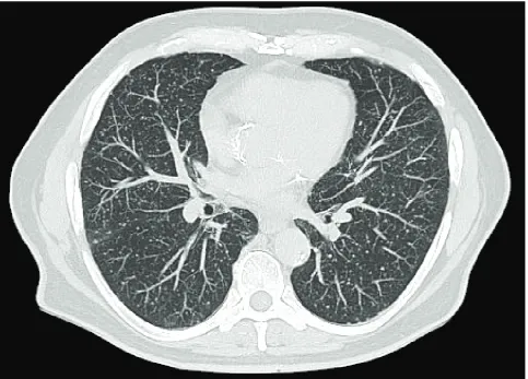 Figure 1 – Computed tomography scan showing pulmonary nodules in a miliary pattern