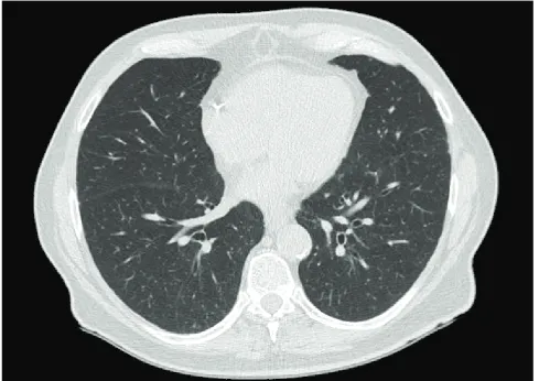 Figure 2 – Axial image of repeat chest computed tomography scans performed 12 months after initiation of anti-tuberculosis medications: showing further improvement with resolution and calcification of many of the intrapulmonary nodules