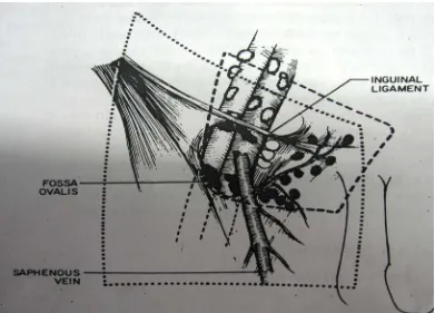 Fig (  )  Comparing the limits of dissection of modified inguinal with 