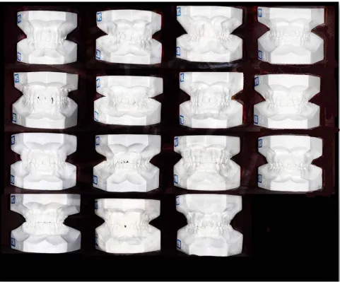 Fig. 1 :  15 pairs of plaster study models used in the study 