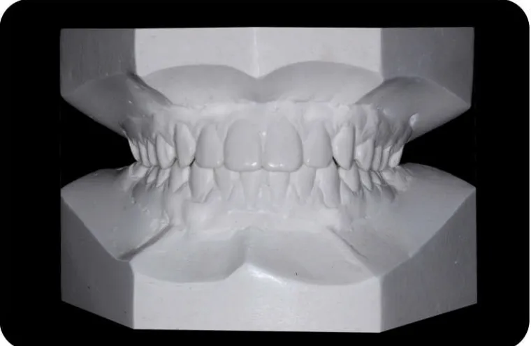 Fig. 3b : Mounted Study Cast