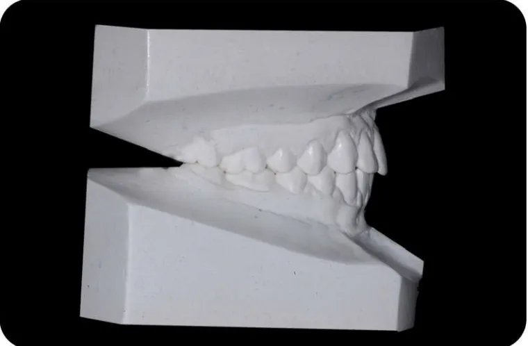 Fig. 3d : Mounted Study Cast