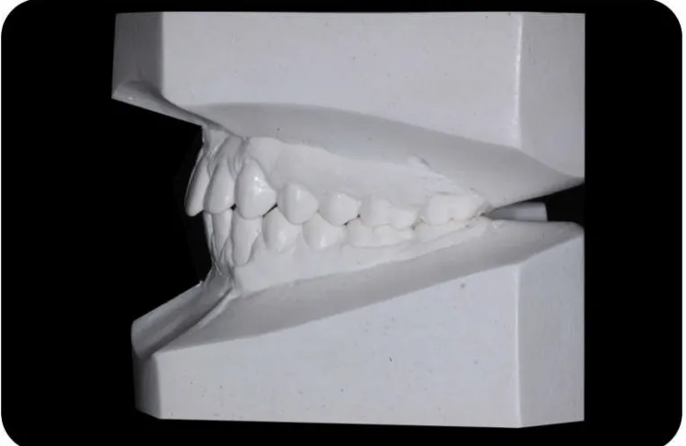 Fig. 3f : Mounted Study Cast