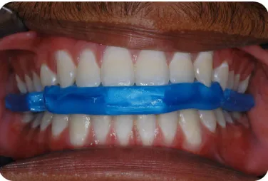 Fig. 11b : ‘Power Centric ’ wax interocclusal registrations