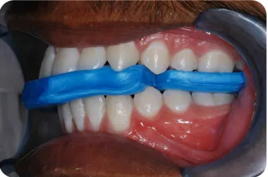 Fig. 11c: ‘Power Centric ’ wax interocclusal registrations