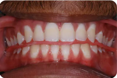 Fig. 12b : MI Bite registrations