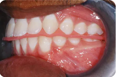 Fig. 12c : MI Bite registrations