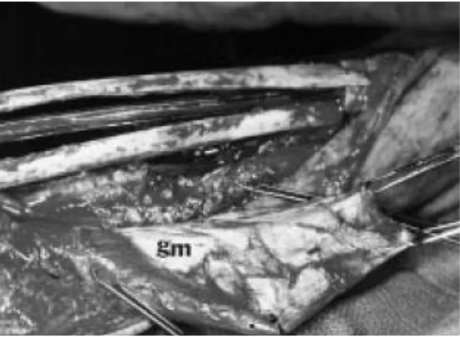 Fig 1. Intraoperative photograph of resection arthrodesis using dual fibular reconstruction 