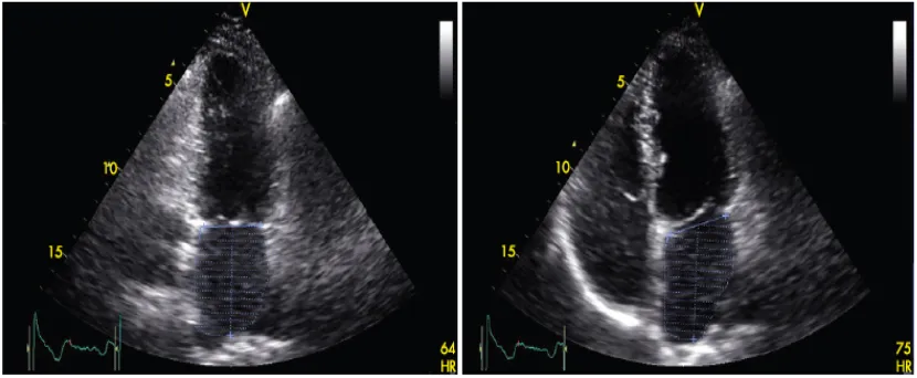 Figure 1: modified biplane Simpson’s rule. The maximum Left Atrial volume is assessed during ventricular systole in the apical two-chamber (left panel) and apical four-chamber (right panel) views