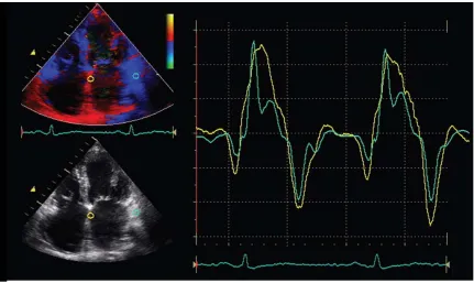 Figure 3: Color-coded tissue Doppler imaging in the apical four-chamber view for the assessment of regional Left Atrial function
