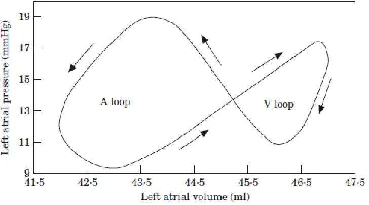 Figure 6: The left atrial pressure–volume relationship is composed of two loops: the A loop, expressing the left atrial pump function and the V loop, expressing the reservoir function of the left atrium