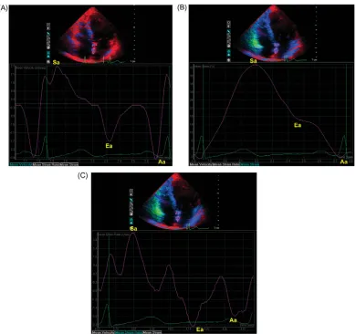 Figure 9:  Assessment of regional atrial myocardial function by tissue Doppler imaging