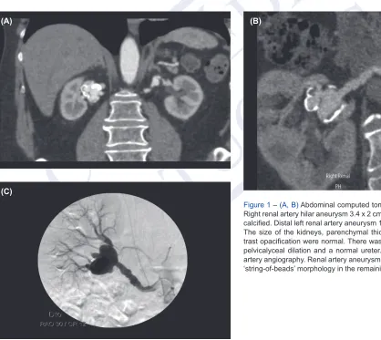 Figure 1 – (A, B) Abdominal computed tomography (CTA). Right renal artery hilar aneurysm 3.4 x 2 cm in diameter and calcified
