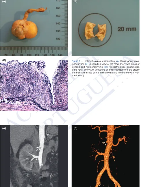 Figure 3 – Histopathological examination. (A) Renal artery mac-