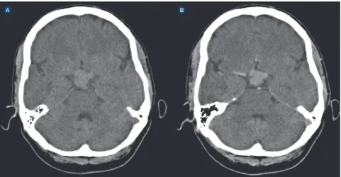 Figure 1 – Initial CT scan in January 2014, before (A) and after (B) IV contrast. A suprasellar lesion with 3 cm in diameter is seen in booth