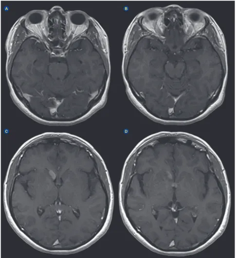Figure 2 – Initial MRI in May 2014. T1 axial weighted images with gadolinium enhancement demonstrate involution of the sellar / supra-in the head of the right caudate nucleus and with subependymal expression (reveals a subependymal nodule in the anterior w