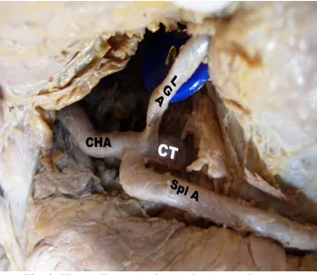 Fig. 2. Hepatolienogastric trunk – normal pattern 