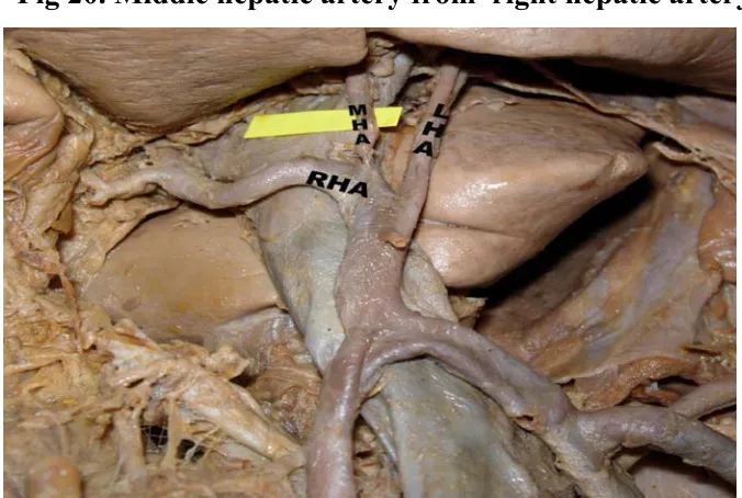 Fig 20. Middle hepatic artery from  right hepatic artery. 