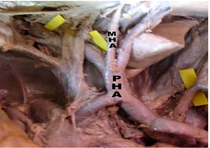 Fig.22. Middle hepatic artery from proper hepatic artery  