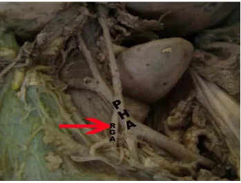 Fig. 23. Right gastric artery from Proper hepatic artery. 