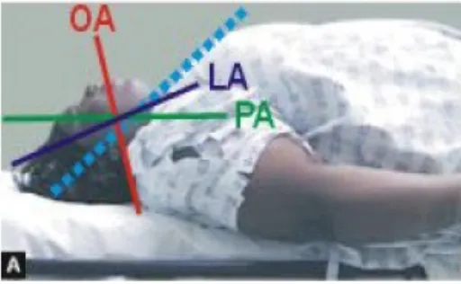 Figure .3. HELP (Head elevated laryngoscopy position (“stacked”or “ramped”)