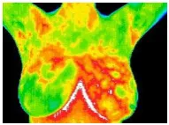 Figure 4. Thermal Image of Cancer Affected Patient 