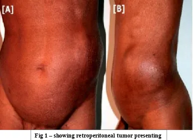 Fig 2 – Intra-operative picture of retroperitoneal 