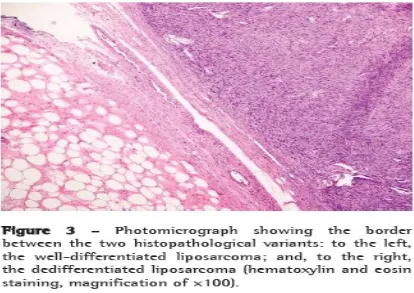 Fig 4- showing a specimen of retroperitoneal liposarcoma