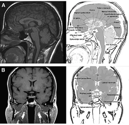 Figure1. Normal anatomy of the human hypothalamic-pituitary unit in sagittal (A) and 