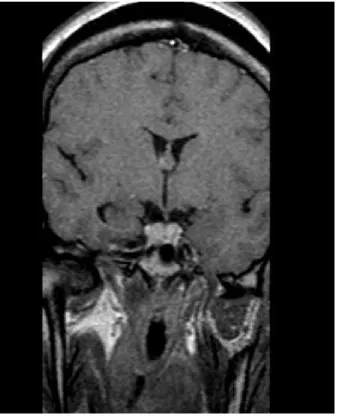 Fig 11(Case 2): MRI (T1 coronal with gadolinium) showing a grade A pituitary   