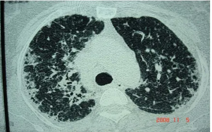 Fig:A Ground Glass Opacity &Traction  Bronchiectasis 