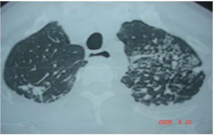 Fig:C Reticulonodular with Honeycombing 