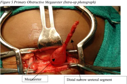 Figure 5 Primary Obstructive Megaureter (Intra-op photograph)