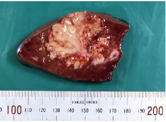Figure 10 Thick yellow pus of Pyogenic liver abscess and Anchovy sauce pus of 