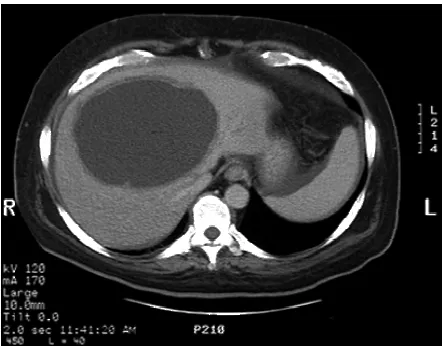 Figure 13 A Plain CT scan demonstrates an amoebic abscess in the right liver. 
