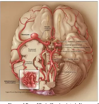 Figure : 4 Base of Brain Showing Arterio Venous malformation