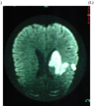 Figure : 10  - C.T. Scan Brain showing (L) MCA territory haemorrhage 