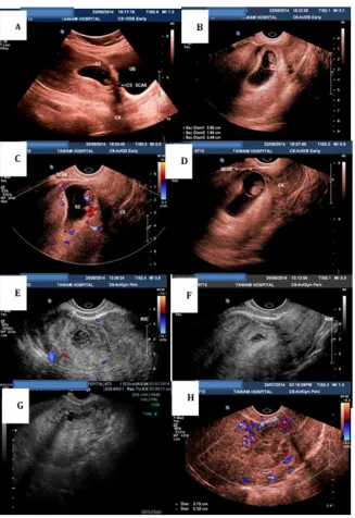Fig. 1. TV scan of case No 6. Pre-treatment (A, B, C &D) & Post-treatment (E-day 1, F &G- day 10 & H-4 weeks)