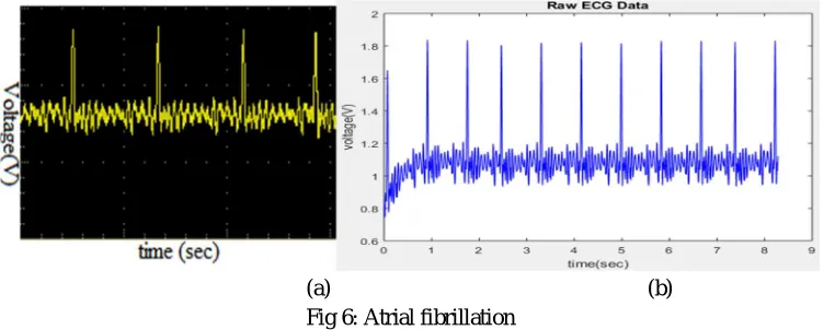 Fig 5: Normal ECG from healthy subject 