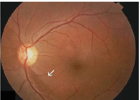 Figure 3‐Localised nerve fibre layer defect 