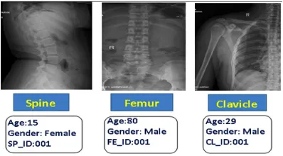 Table 3. Interpretation of Clavicle X- Ray images